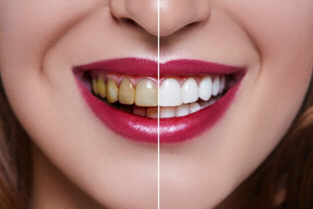 Close-up of a woman's smile showing a before and after comparison of teeth whitening, with yellowed teeth on one side and bright white teeth on the other