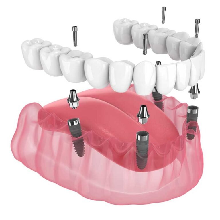 all on 4 dental implants 768x768