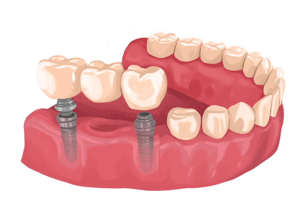 implant supported bridge 1024x736